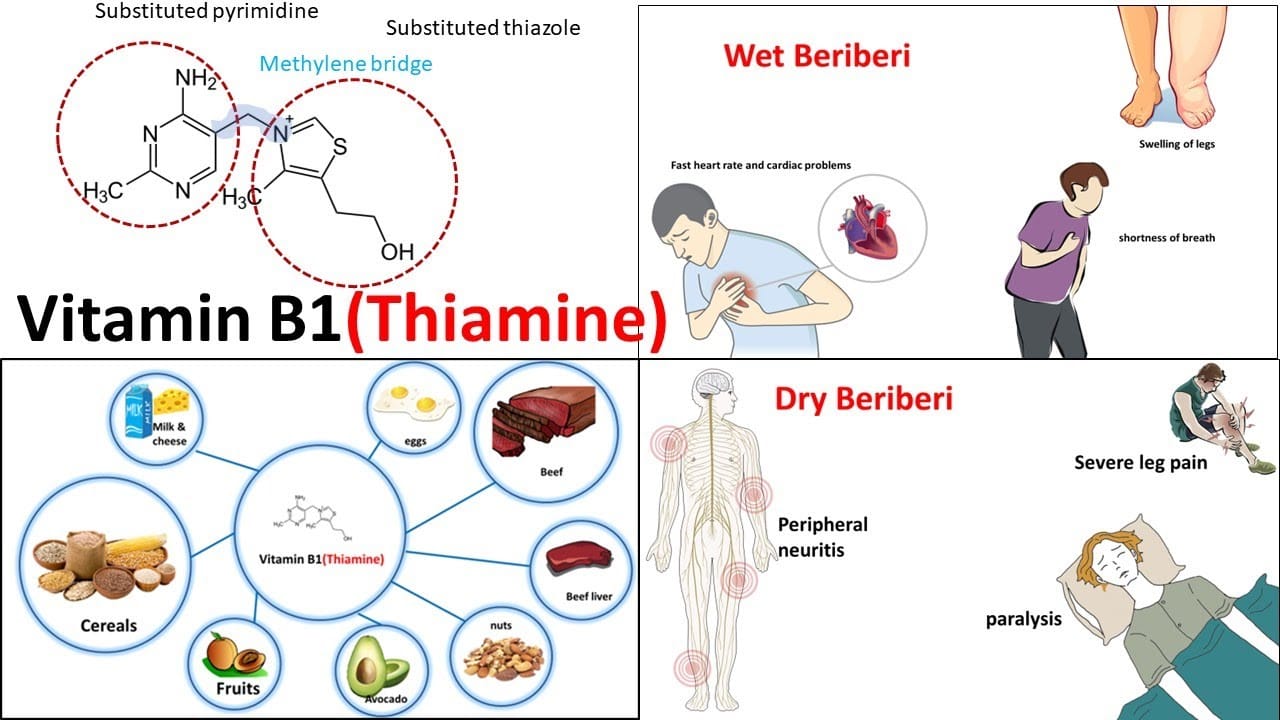 Thiamine Deficiency